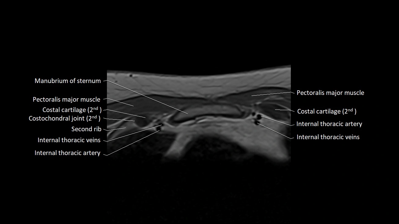 MRI sternum and sternoclavicular joint labeled axial anatomy image 11.webp